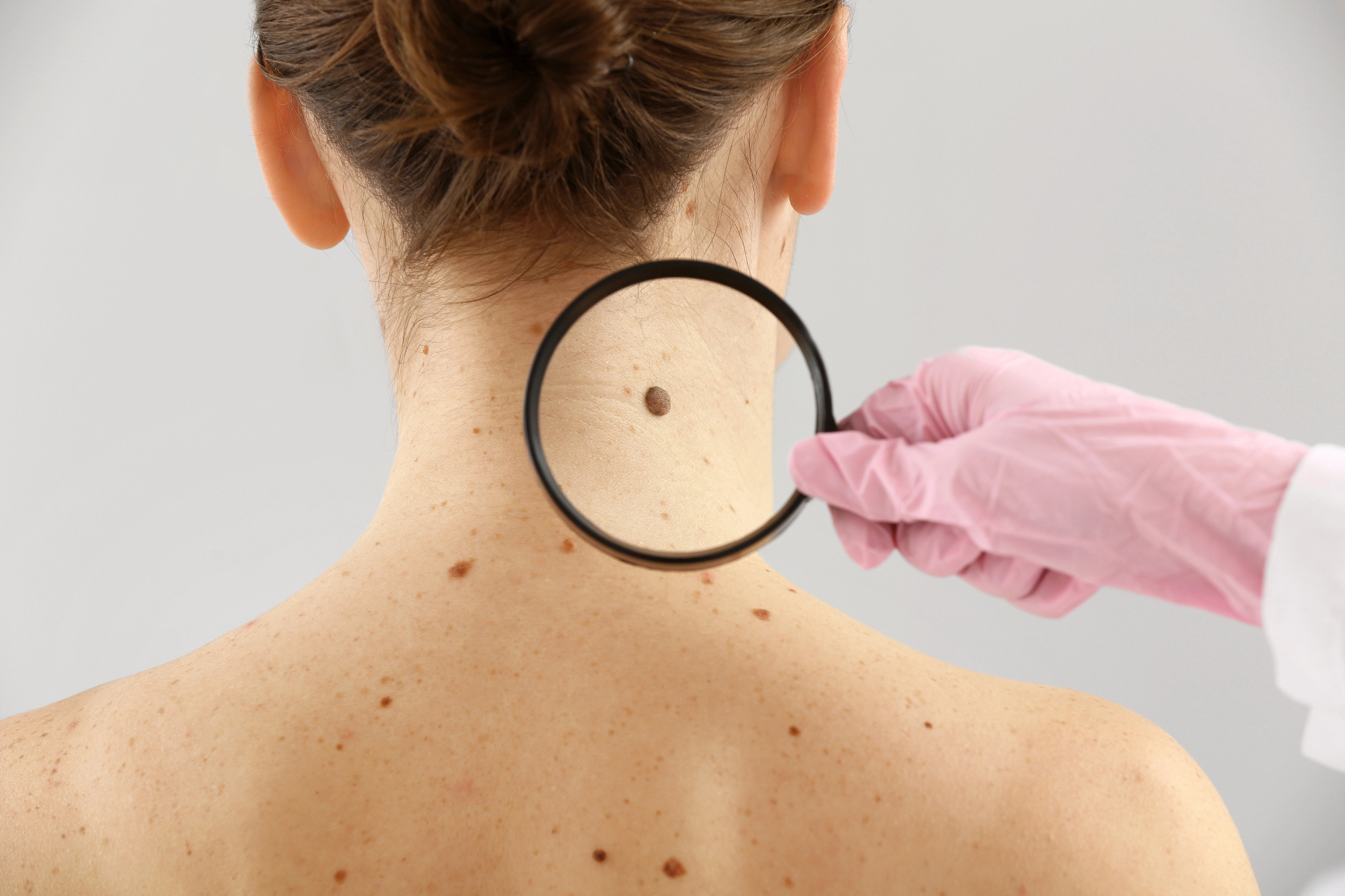 Dermatologija Koper mi je lahko hitro pomagala